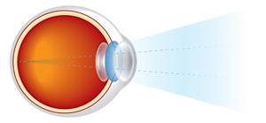eye diagram by eye doctor near allentown, pa