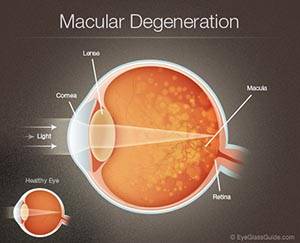 There S No Cure For Macular Degeneration But We Can Treat It