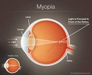 Myopia graph from Weymouth's #1 Eye Care Clinic